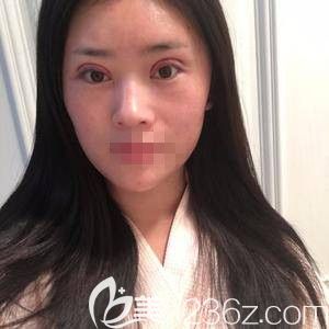 在鄭州華領(lǐng)做自體脂肪填充和眼綜合術(shù)后<span style= 在鄭州華領(lǐng)做自體脂肪填充和眼綜合術(shù)后<span style=