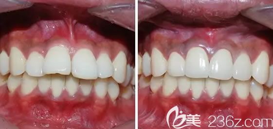 鄭州拜博口腔隱形牙齒矯正案例 鄭州拜博口腔隱形牙齒矯正案例