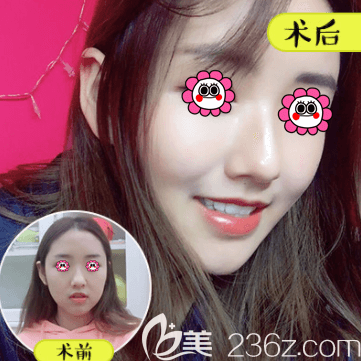 北京壹加壹田瑩醫(yī)生玻尿酸豐蘋果肌案例