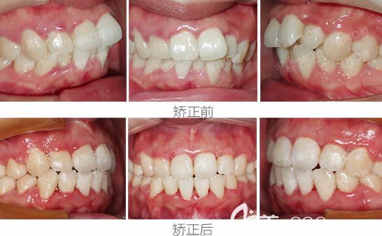 骨性齙牙兼牙列不齊在廈門(mén)登特口腔矯正兩年后，使30歲的我側(cè)臉逆襲
