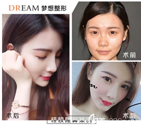 蘭州時(shí)光相伴趙美霞醫(yī)生硅膠假體隆鼻