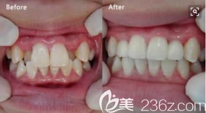 重慶維樂周姣醫(yī)生青少年牙齒擁擠矯正前后對比效果 重慶維樂周姣醫(yī)生青少年牙齒擁擠矯正前后對比效果