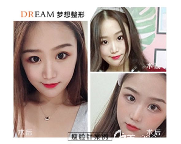 蘭州夢(mèng)想陳元捷隆鼻