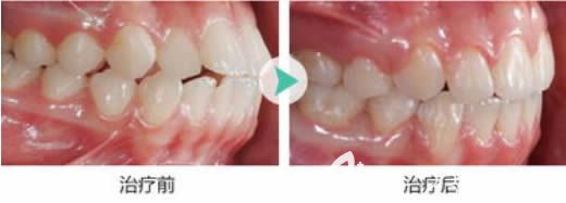 重慶維樂口腔周姣醫(yī)生28歲矯正牙齒前后對比照 重慶維樂口腔周姣醫(yī)生28歲矯正牙齒前后對比照