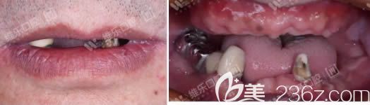 60歲老人在重慶維樂口腔做種植牙術前照 60歲老人在重慶維樂口腔做種植牙術前照