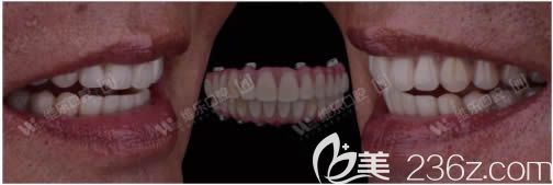 讓劉繼洪醫(yī)生做完全口種植牙后的照片 讓劉繼洪醫(yī)生做完全口種植牙后的照片