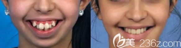 重慶維樂口腔青少年虎牙矯正前后對(duì)比效果 重慶維樂口腔青少年虎牙矯正前后對(duì)比效果