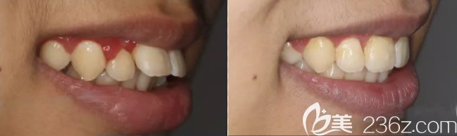 重慶維樂口腔楊國平醫(yī)生青少年深覆蓋矯正前后對比照 重慶維樂口腔楊國平醫(yī)生青少年深覆蓋矯正前后對比照