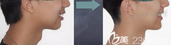 深覆蓋矯正后臉型變化圖 深覆蓋矯正后臉型變化圖