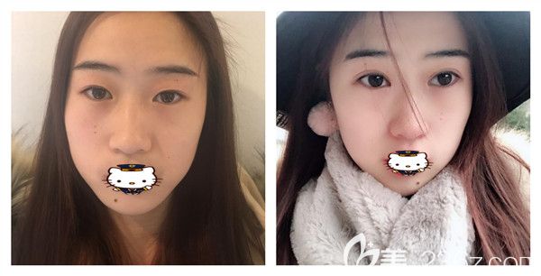 割雙眼皮武漢吳秀英以全切雙眼皮+開(kāi)內(nèi)眼角案例展示 割雙眼皮武漢吳秀英以全切雙眼皮+開(kāi)內(nèi)眼角案例展示