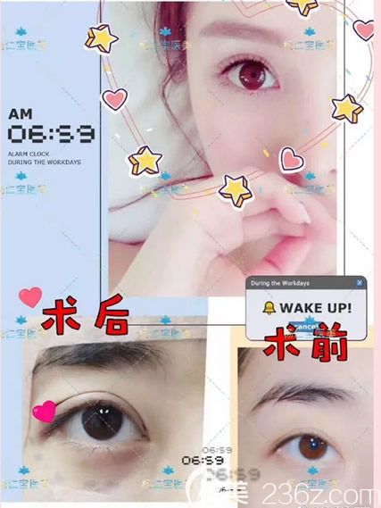 呼市五洲楊仁寶做雙眼皮修復效果怎么樣