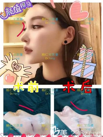 五洲醫(yī)院楊仁寶假體隆鼻+自體軟骨綜合隆鼻案例