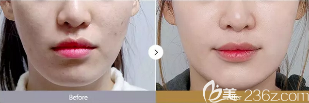 韓國ID熱瑪吉真人案例效果對比圖