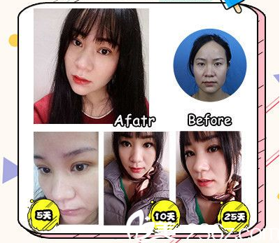 廣州軍美醫(yī)美產(chǎn)慎之雙眼皮案例 廣州軍美醫(yī)美產(chǎn)慎之雙眼皮案例