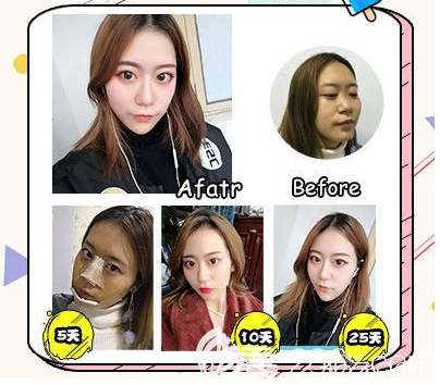 廣州軍美醫(yī)美產(chǎn)慎之隆鼻手術(shù)案例 廣州軍美醫(yī)美產(chǎn)慎之隆鼻手術(shù)案例