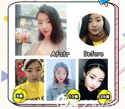 廣州軍美產(chǎn)慎之醫(yī)生線雕提升案例 廣州軍美產(chǎn)慎之醫(yī)生線雕提升案例