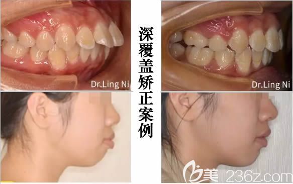 重慶維樂口腔成人深覆蓋牙齒矯正案例效果圖 重慶維樂口腔成人深覆蓋牙齒矯正案例效果圖