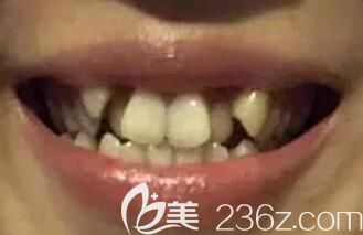 我在鄭州拜博口腔做虎牙矯正前的照片 我在鄭州拜博口腔做虎牙矯正前的照片
