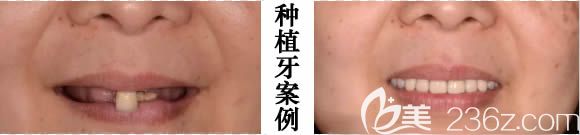重慶維樂口腔全口數(shù)字化種植牙前后對比效果圖 重慶維樂口腔全口數(shù)字化種植牙前后對比效果圖