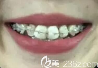 我在拜博口腔做陶瓷托槽牙齒矯正第9個月 我在拜博口腔做陶瓷托槽牙齒矯正第9個月