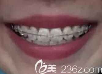 我在鄭州拜博口腔做牙齒矯正第12個月 我在鄭州拜博口腔做牙齒矯正第12個月