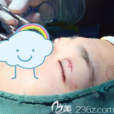 武漢卓美吳秀英主任全切雙眼皮+開內(nèi)眼角術后0天 武漢卓美吳秀英主任全切雙眼皮+開內(nèi)眼角術后0天