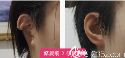 北京米蘭柏羽麗都耳缺損修復(fù)案例 北京米蘭柏羽麗都耳缺損修復(fù)案例