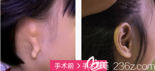 北京米蘭柏羽麗都小耳畸形修復(fù)案例 北京米蘭柏羽麗都小耳畸形修復(fù)案例