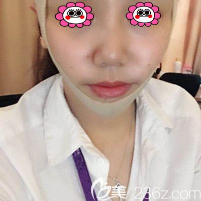 做完線雕后的第三天恢復(fù)圖