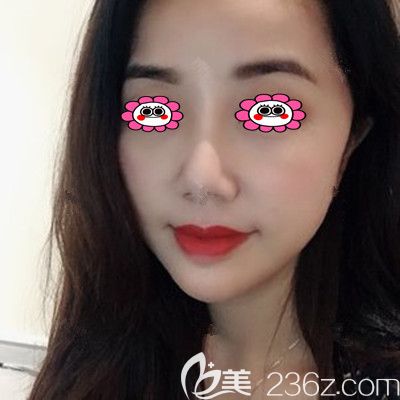 線雕提升一周后的圖片