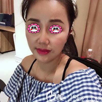 面部線雕后第二個(gè)月效果圖