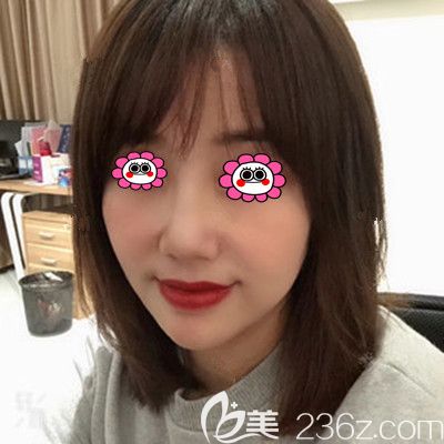 在衡陽美萊做完面部線雕4個(gè)月后打卡，原來“甜顏”比“蜜語”更重要