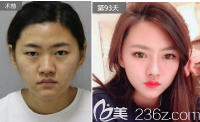 淄博美聯(lián)臣整形醫(yī)院雙眼皮案例