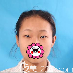 在北京美萊做全切雙眼皮前樣子 在北京美萊做全切雙眼皮前樣子