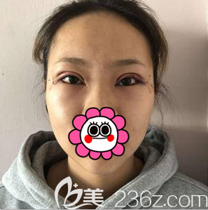 葉宇醫(yī)生給我做全切雙眼皮第7天效果 葉宇醫(yī)生給我做全切雙眼皮第7天效果