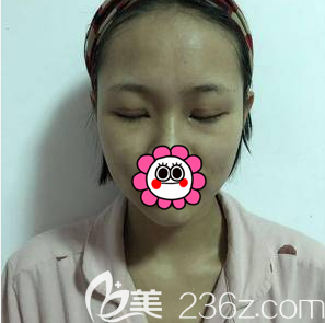 在北京美萊做全切雙眼皮第15天效果 在北京美萊做全切雙眼皮第15天效果