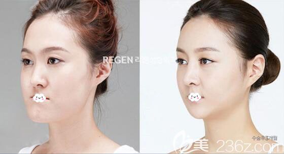 韓國麗珍吳銘俊雙鄂手術(shù)將凸嘴矯正案例效果圖