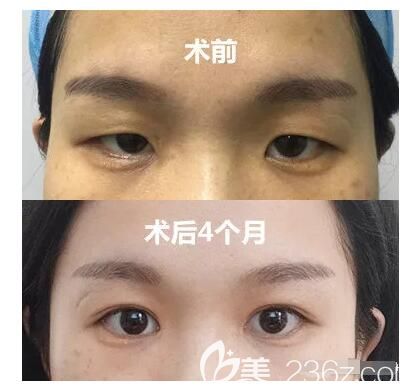 路長(zhǎng)飛主任雙眼皮案例對(duì)比照 路長(zhǎng)飛主任雙眼皮案例對(duì)比照