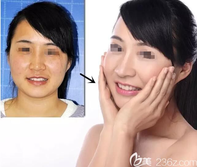 同事到無錫愛思特祛斑前后對比案例