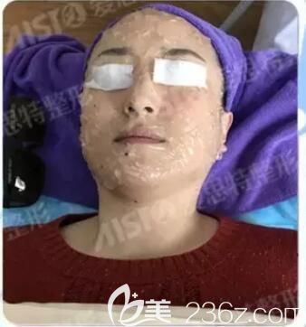 大Q祛斑術(shù)前面部涂抹麻醉膏