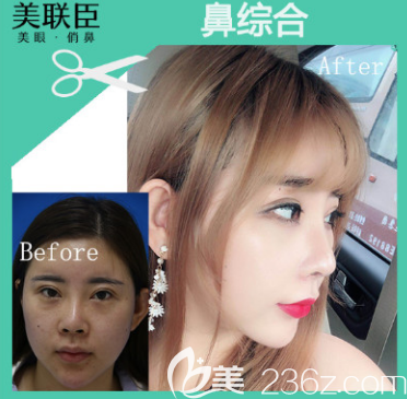 淄博美聯(lián)臣整形醫(yī)院鼻綜合案例