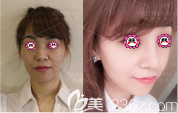 醫(yī)美王小東醫(yī)生假體隆鼻案例