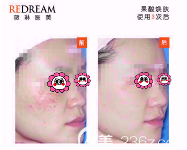 劉麗醫(yī)生果酸煥膚案例