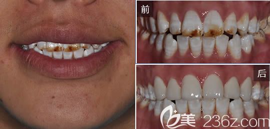 廣州圣貝口腔趙艷明牙齒貼面效果對比 廣州圣貝口腔趙艷明牙齒貼面效果對比