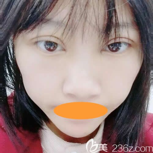 西寧時光醫(yī)院薛院長給我做全切雙眼皮術(shù)后第7天 西寧時光醫(yī)院薛院長給我做全切雙眼皮術(shù)后第7天