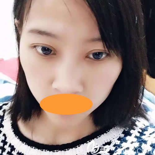 西寧時光醫(yī)院薛院長給我做全切7mm雙眼皮術(shù)后第21天 西寧時光醫(yī)院薛院長給我做全切7mm雙眼皮術(shù)后第21天