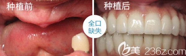 全口種植重建前后效果圖 全口種植重建前后效果圖