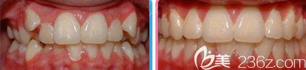 牙齒矯正效果案例 牙齒矯正效果案例