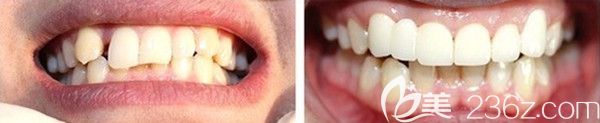 牙齒美學修復變化圖 牙齒美學修復變化圖