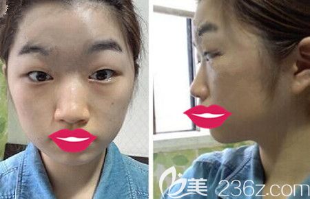 在韓國(guó)德萊茵做面部輪廓+眼鼻整形術(shù)前 在韓國(guó)德萊茵做面部輪廓+眼鼻整形術(shù)前